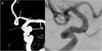 The Use of Flow Diverting Stents to Treat Para-Ophthalmic Aneurysms